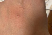 被貓抓了一下輕微破皮要打針嗎-被貓抓了一下輕微破皮要打針嗎？-大智網匯